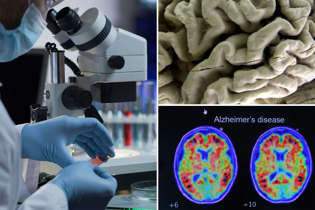 Alzheimer'li Olma Riskini Belirten Kan Testi Gelisiyor